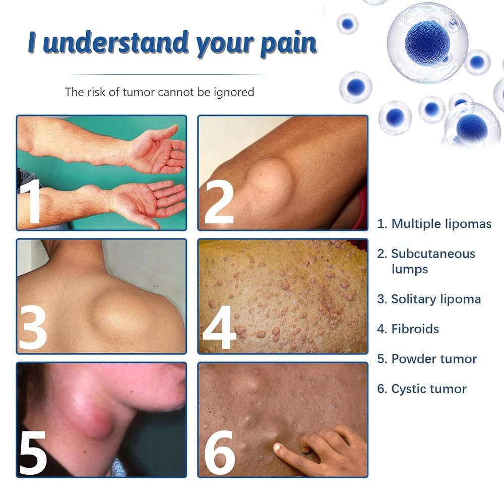 Lipo-PRO Lipoma Removal Cream | External Care for Skin Lumps
