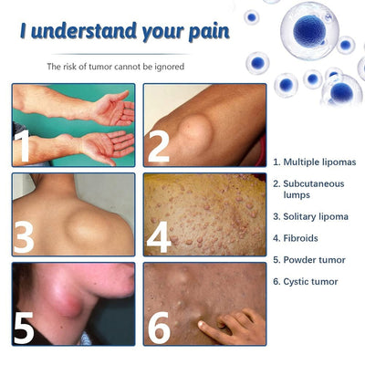 Lipo-PRO Lipoma Removal Cream | External Care for Skin Lumps