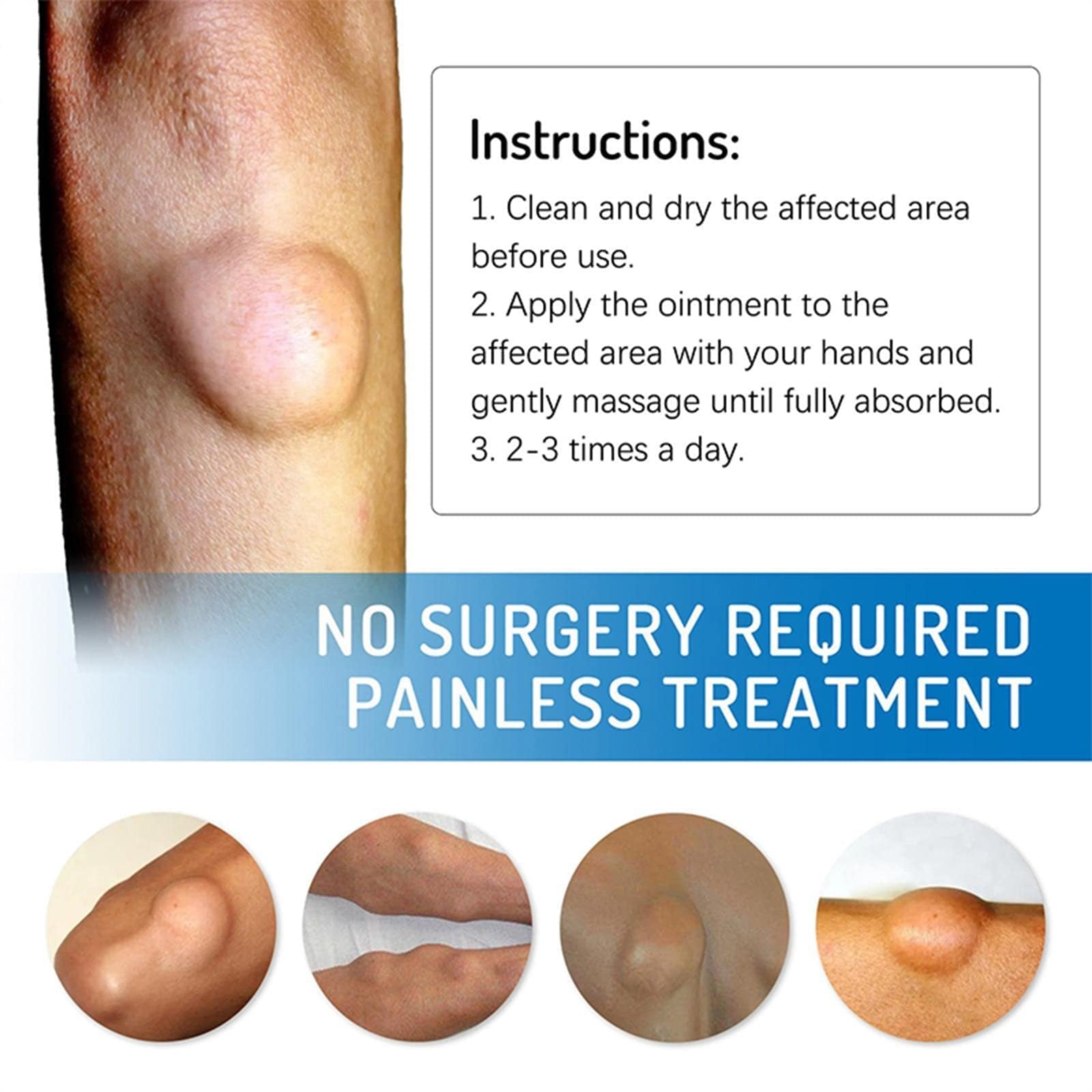 Lipo-PRO Lipoma Removal Cream | External Care for Skin Lumps