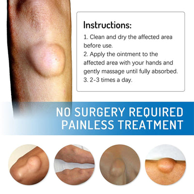 Lipo-PRO Lipoma Removal Cream | External Care for Skin Lumps
